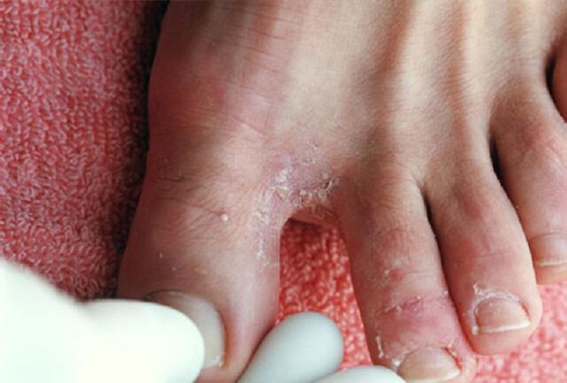 Projevy intertriginózní houby mezi prsty na nohou