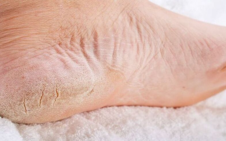 příznaky plísní na nohou