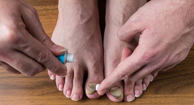 léčba nehtů nehtů na nohou
