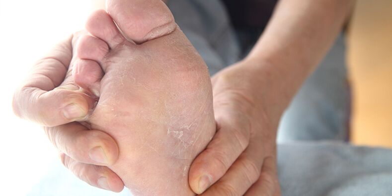kožní léze s plísní na nohou
