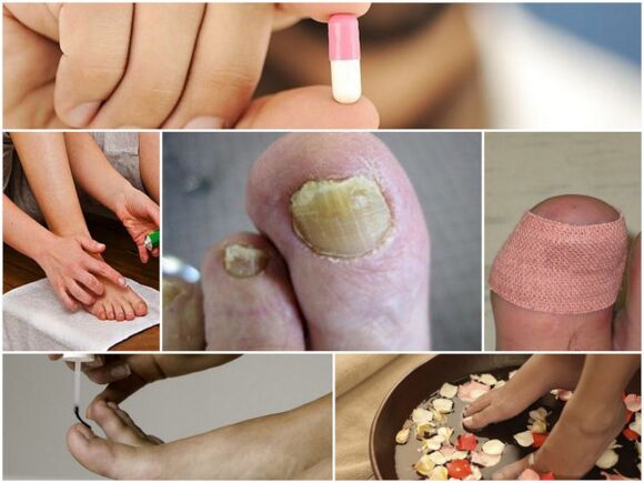 druhy léků na nehty nehtů na nohou