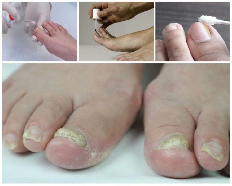 léky na nehty nehtů na nohou