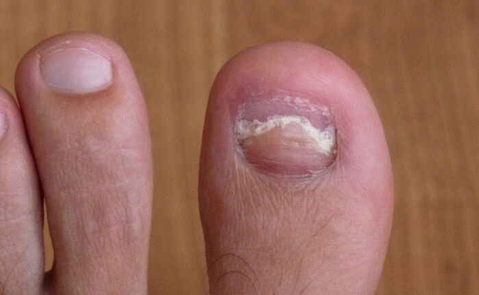 poškození nehtu na palci na noze plísní