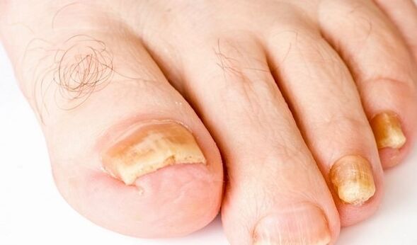 fotografie příznaků houby nehtů na nohou