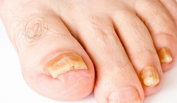 žluté nehty na nohou pro plísňové infekce